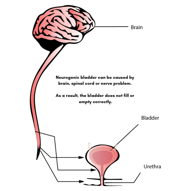 Spinal Cord Injuries and Neurogenic Bladders - CompactCath