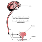 Spinal Cord Injuries: Impact on the Bladder & Bowel - CompactCath