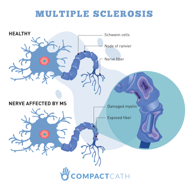 Bladder Management with Multiple Sclerosis - CompactCath