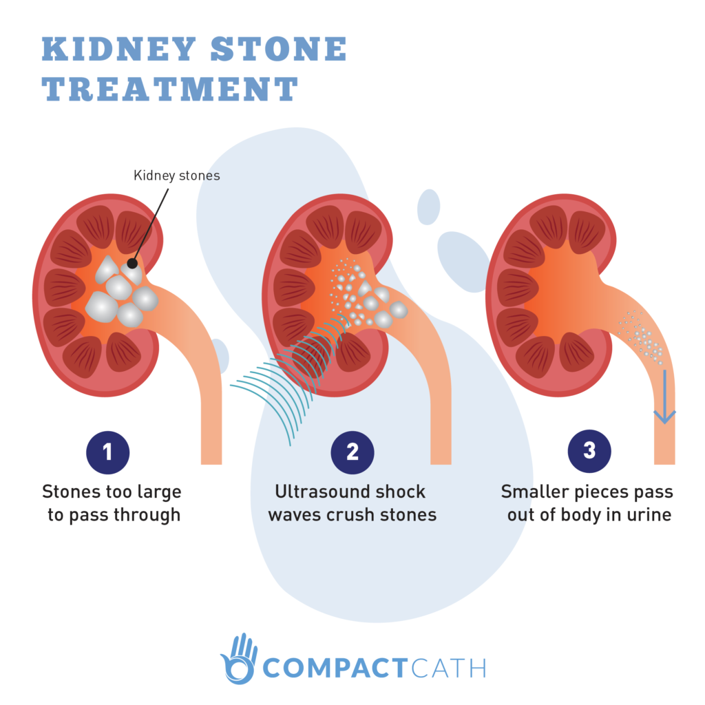 Kidney Stones The Ultimate Beginner S Guide Compactcath