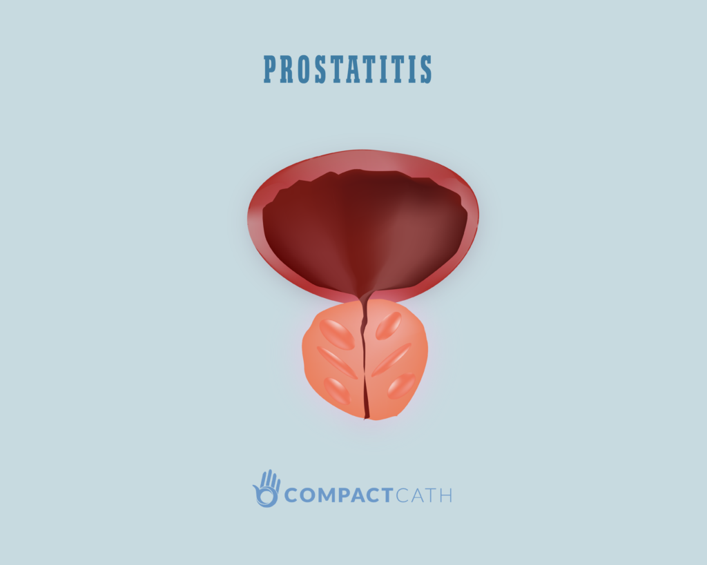 What Are The Four Types Of Prostatitis Causes Symptoms And