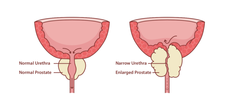 urinary-retention-types-causes-symptoms-diagnosis-treatment