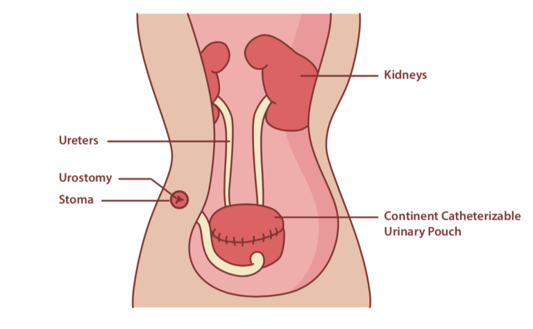 Indiana Pouch Surgery Complications And Catheterization Compactcath 